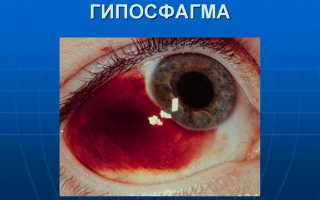 Что такое ушиб глаза и как его лечить