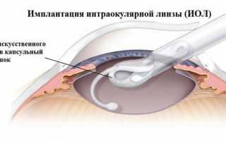 Причины гиперметропии средней степени, симптоматика, лечение и осложнения
