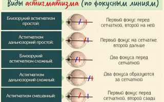 Выбор очков при астигматизме