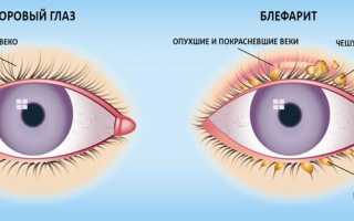 Лечение миопии слабой степени