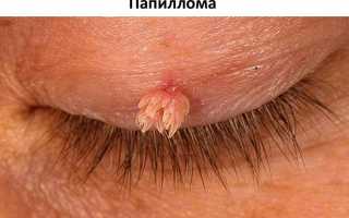 Почему на глазу может появиться прозрачный пузырек