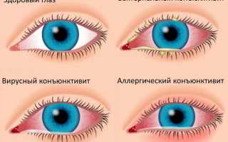 Правила извлечения линзы из глаза