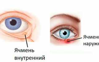 Лечение ячменя на нижнем веке
