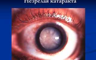 Симптомы и особенности лечения при незрелой катаракте