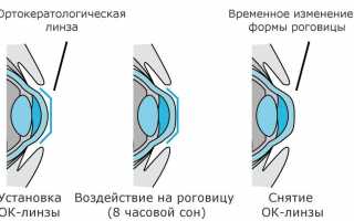 Как правильно пользоваться ночными линзами для восстановления зрения