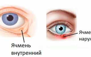 Как можно предотвратить развитие ячменя на глазу