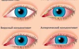 Почему глаза чешутся и краснеют и что с этим делать