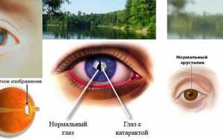 Как применять средство от катаракты Катаксол