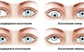 Почему косят глазки у новорождённых