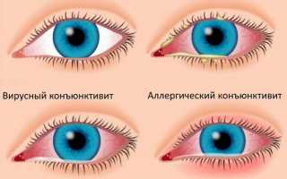 Почему щиплет глаза