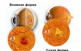 Применение Эмоксипина в офтальмологии в качестве лечебных инъекций